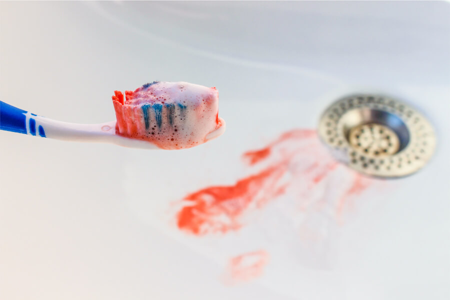 Closeup of a toothbrush and sink with blood from bleeding gums, one of the early warning signs of gum disease