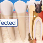 illustration of an infected tooth needing root canal therapy