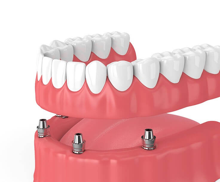 illustration of implant-supported dentures