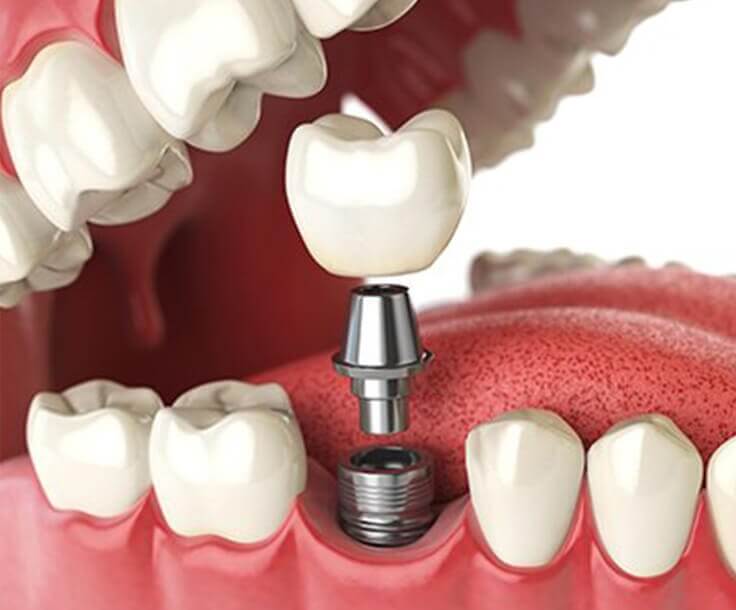 illustration of a dental implant