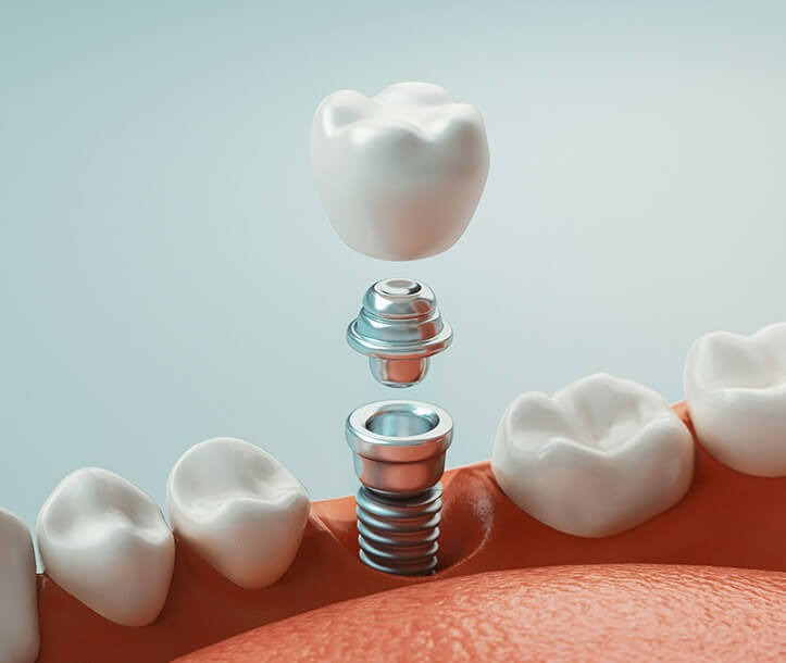 illustration of dental implants